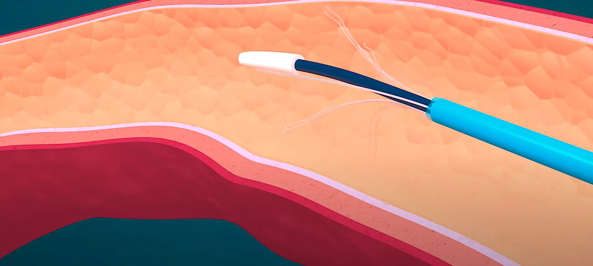 Flebogrif Katheter im Gefäß