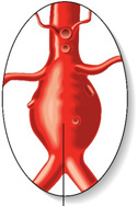 Ausweitung der Gefäße (Aneurysma)