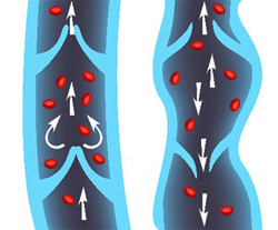 Krampfadererkrankung (Varicosis)